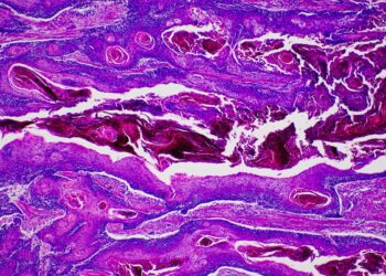 oms-alerta-que-novos-casos-de-cancer-podem-quase-duplicar-ate-2050