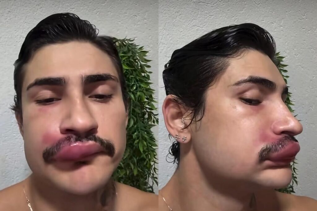 triangulo-da-morte:-espremer-espinha-no-rosto-pode-causar-infeccao