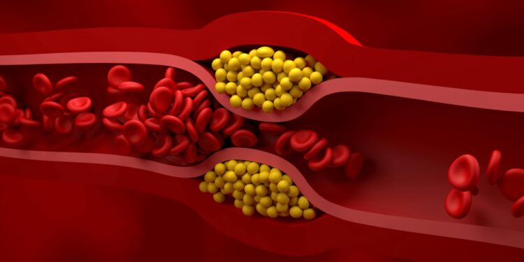 tratamento-de-colesterol-pode-remover-pfas-e-microplasticos-do-sangue