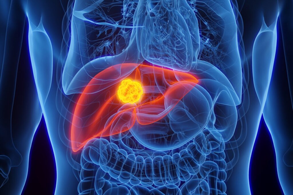 novo-exame-de-dna-pode-identificar-cancer-e-doenca-hepatica-no-inicio