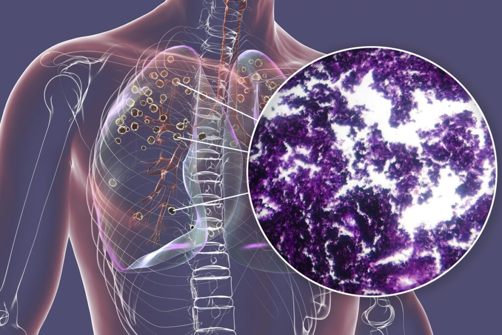 tosse-persistente-pode-ser-sintoma-de-cancer-de-pulmao,-alertam-medicos
