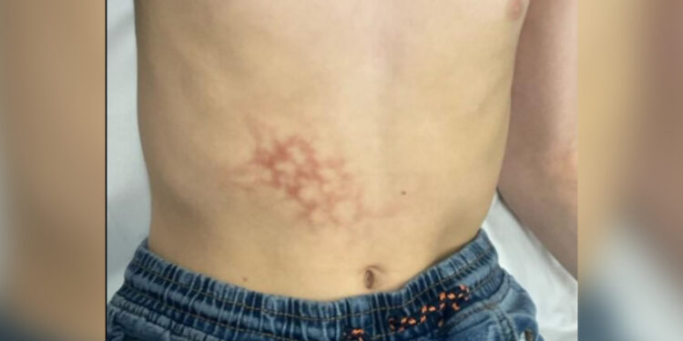 menino-desenvolve-dermatose-rara-por-usar-notebook-encostado-na-barriga