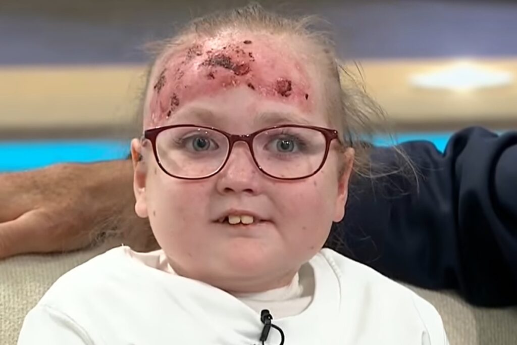 doenca-rara-deixa-menina-de-14-anos-com-bolhas-e-dor-por-todo-o-corpo