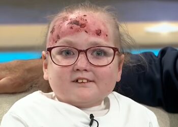 doenca-rara-deixa-menina-de-14-anos-com-bolhas-e-dor-por-todo-o-corpo