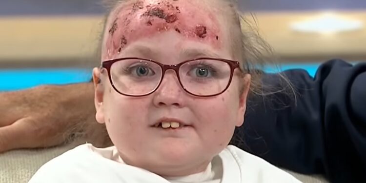 doenca-rara-deixa-menina-de-14-anos-com-bolhas-e-dor-por-todo-o-corpo