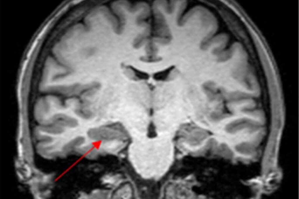 caso-de-convulsao-na-menstruacao-levanta-suspeita-de-endometriose-cerebral