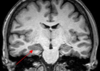 caso-de-convulsao-na-menstruacao-levanta-suspeita-de-endometriose-cerebral