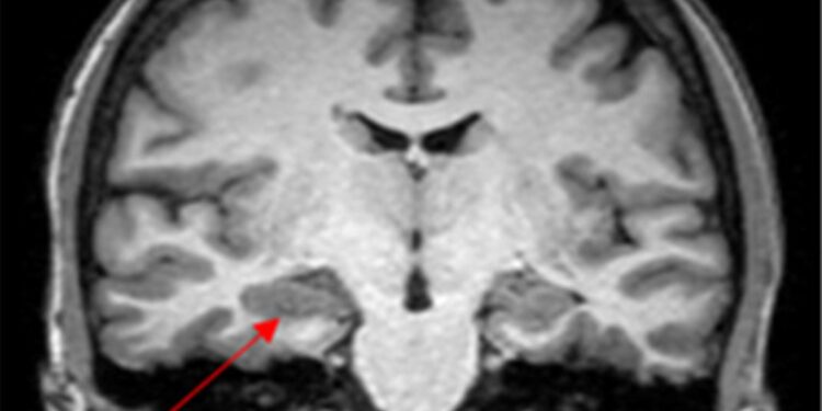 caso-de-convulsao-na-menstruacao-levanta-suspeita-de-endometriose-cerebral